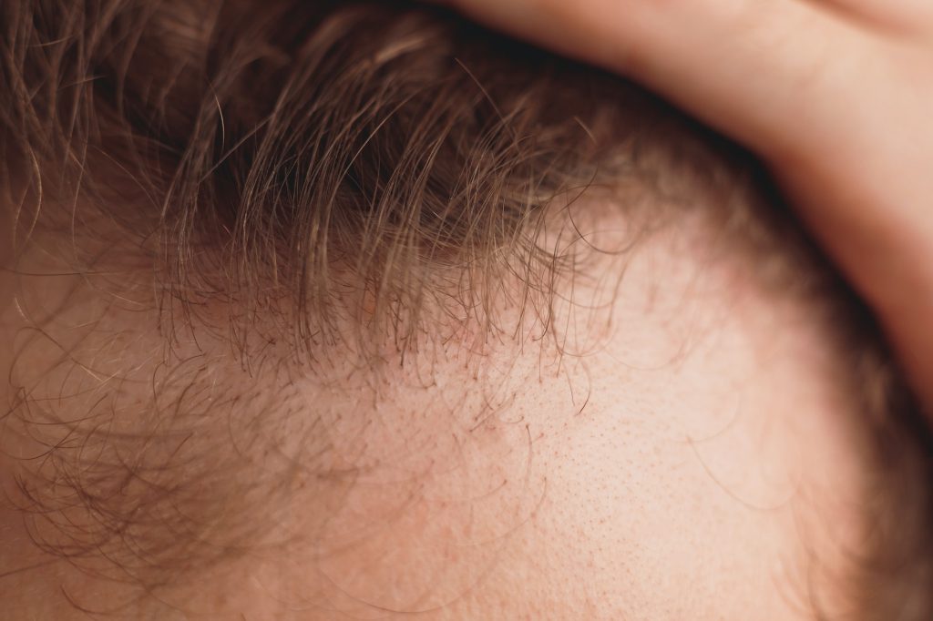 balding man is opening his forehead, close up view